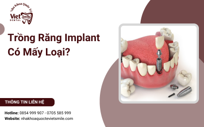Trồng Răng Implant Có Mấy Loại?