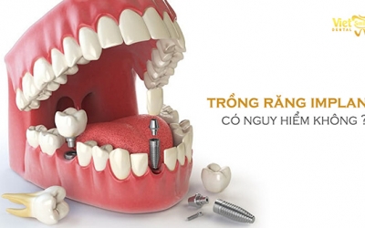 Trồng răng Implant có nguy hiểm không? 4 biến chứng nguy hiểm nếu trồng răng Implant sai cách