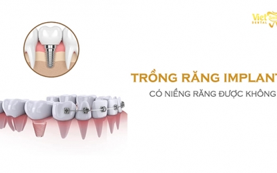 Trồng răng Implant có niềng răng được không? Cách chăm sóc răng Implant sau khi niềng đúng cách