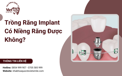 Trồng Răng Implant Có Niềng Răng Được Không?