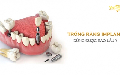 Trồng răng Implant dùng được bao lâu? Có bảo đảm an toàn không?