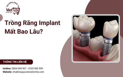 Trồng Răng Implant Mất Bao Lâu?