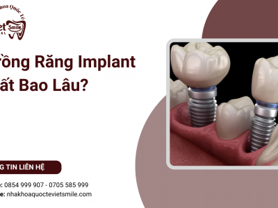 Trồng Răng Implant Mất Bao Lâu?