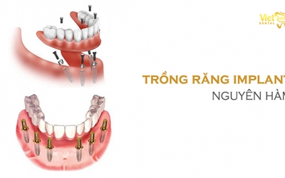 Trồng răng Implant nguyên hàm – Giải pháp tốt nhất cho mất răng toàn hàm