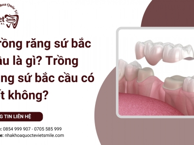 Trồng răng sứ bắc cầu là gì? Trồng răng sứ bắc cầu có tốt không?