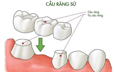 Có nên trồng răng sứ khi bị mất răng với phương pháp cầu răng sứ?