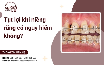 Tụt lợi khi niềng răng có nguy hiểm không?