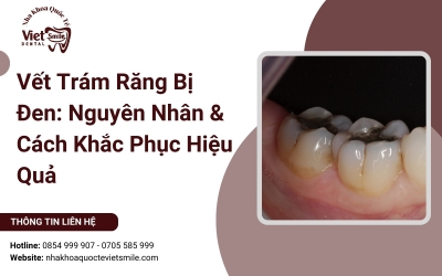 Vết Trám Răng Bị Đen: Nguyên Nhân & Cách Khắc Phục Hiệu Quả
