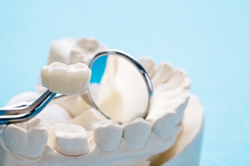 Bọc răng sứ bị lệch khớp cắn: Nguyên nhân và cách khắc phục