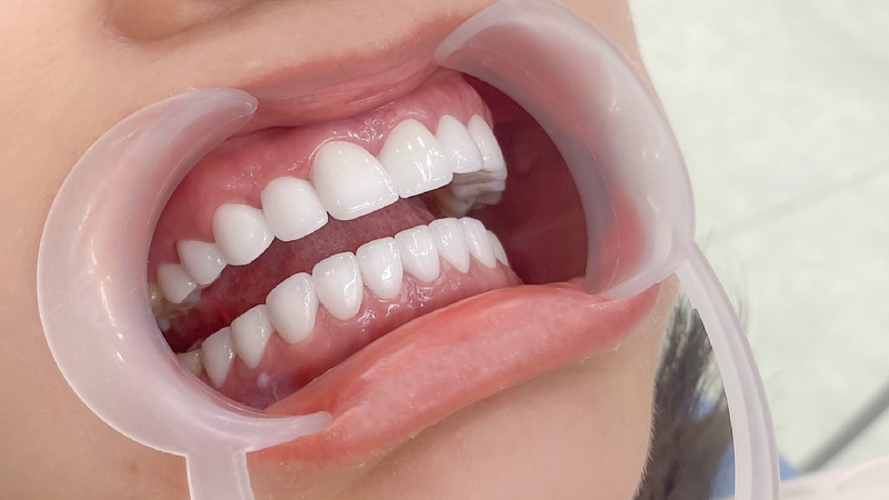 Chia sẻ kinh nghiệm chăm sóc răng sứ an toàn sau khi bọc