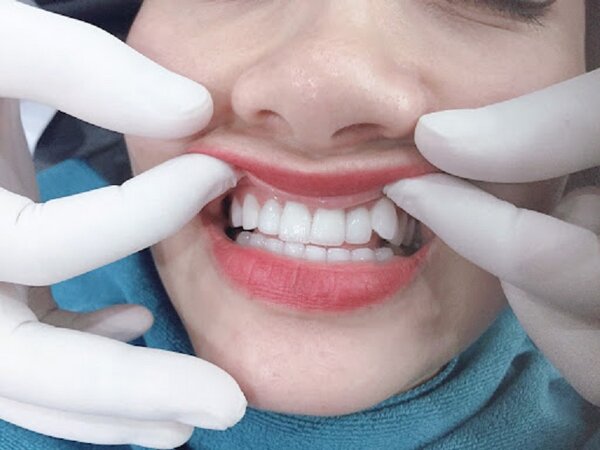 Răng khểnh đẹp hay xấu? Tính cách của người răng khểnh