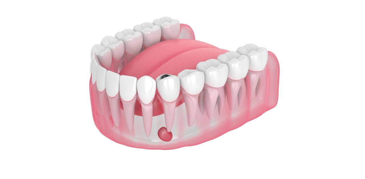 Viêm Lợi Sau Khi Bọc Răng Sứ: Nguyên Nhân Và Cách Khắc Phục