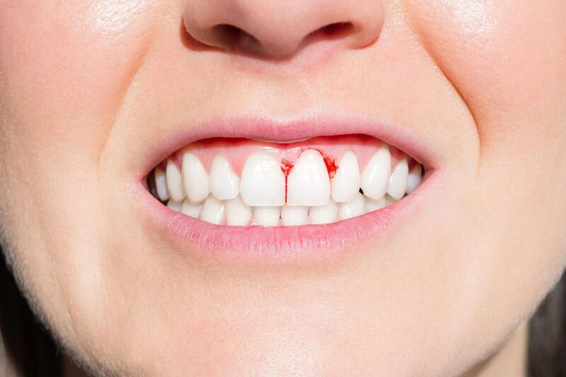 Tại sao bọc răng sứ bị viêm lợi? Nguyên nhân và giải pháp | Nha Khoa Quốc Tế Việt Smile