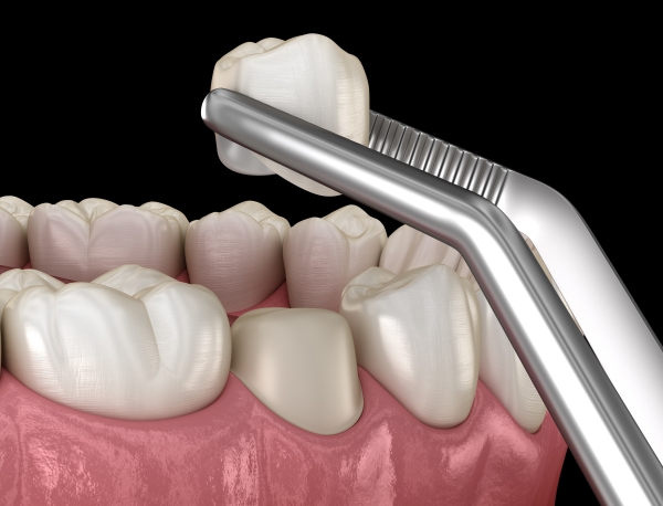 Bọc răng sứ có đau không? Có ê buốt, khó chịu không?