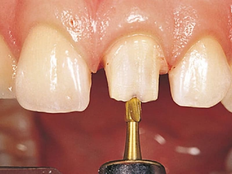 Mài cùi răng là gì? Nguyên tắc mài cùi răng đúng tiêu chuẩn là như thế nào?