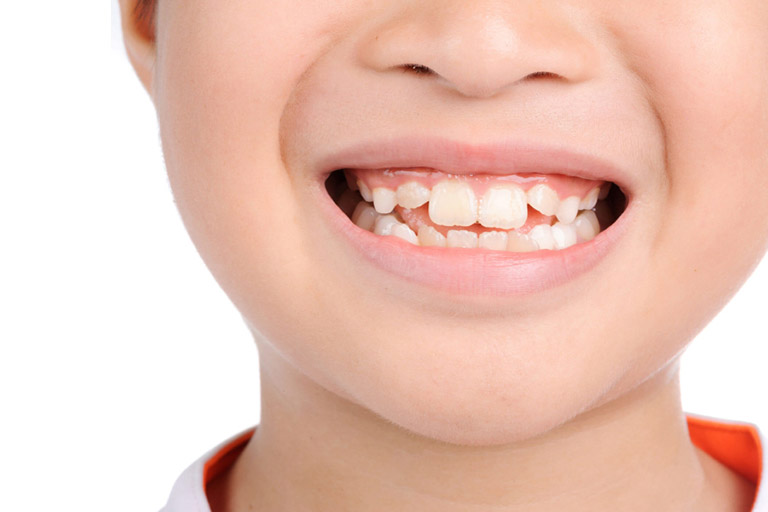 Răng mọc lộn xộn: Nguyên nhân và biện pháp khắc phục – Wiki Nha Khoa