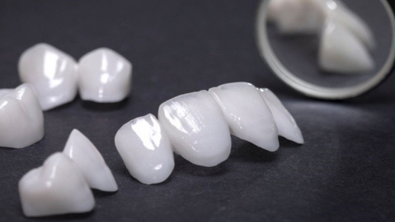 Răng sứ Venus và tất tần tật thông tin bạn cần biết - Nhà thuốc FPT Long Châu