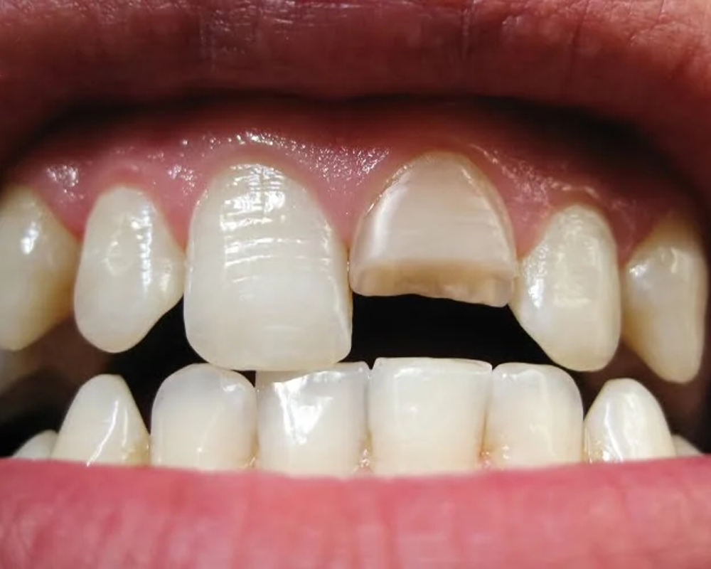 Gãy răng cửa có ảnh hưởng gì không? Làm sao để khắc phục? - Nha khoa Parkway - Người bạn trọn đời