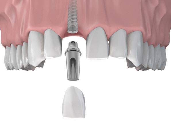 Implant Răng Cửa: Trồng Implant Mất Bao Lâu? Có Đau Không? Có Bền Không?