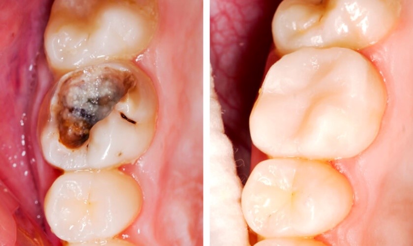 Trám Răng Sâu Và Một Số Lưu Ý Mà Bạn Cần Biết