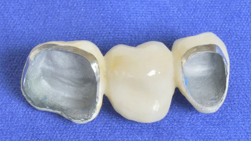 Răng sứ kim loại là gì? Có tốt không và Giá bao nhiêu?