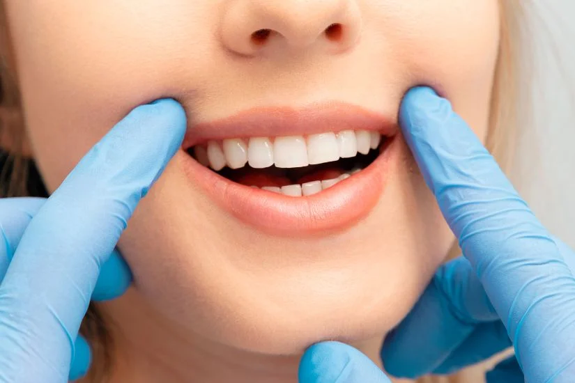 Bọc răng sứ cần kiêng gì? Chế độ ăn uống sau làm