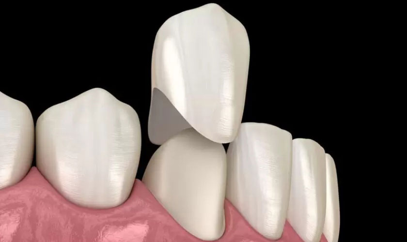 Răng sứ tháo ra có lắp lại được không?