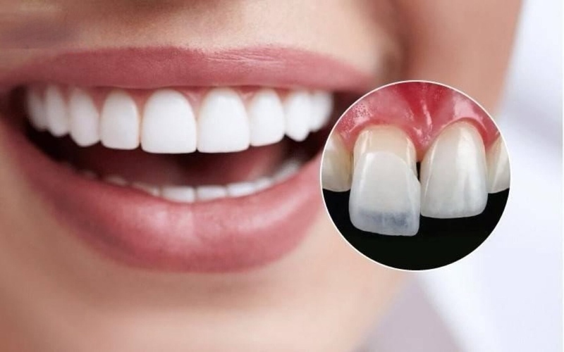 Mặt dán sứ Veneer có tốt không? Ưu nhược điểm của Veneer