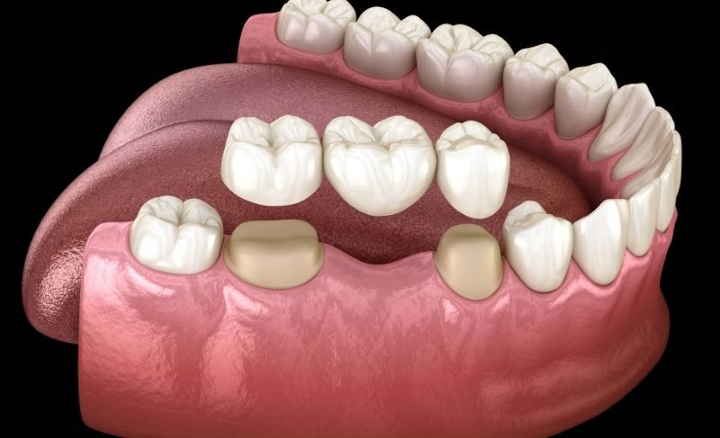 Làm cầu răng sứ có thật sự tốt không? - NhaKhoaLinhXuan.com