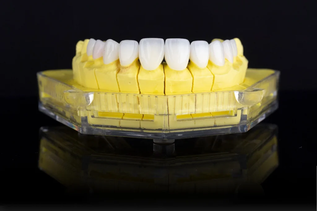 Tất tần tật về Răng sứ Orodent và 5 lợi ích vượt trội