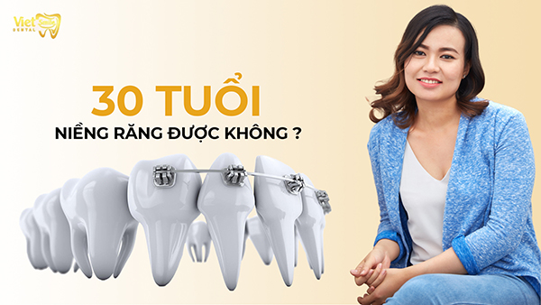 30 tuổi niềng răng được không, đã có lời giải đáp