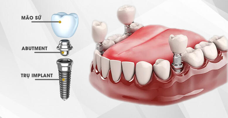 Trồng răng Implant là gì? Ưu nhược điểm của phương pháp trồng implant