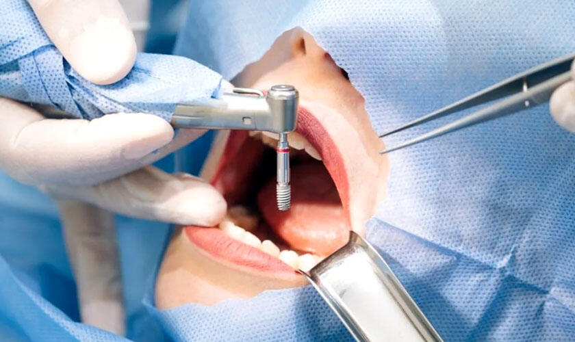 Không tuân thủ đúng quy trình trồng implant