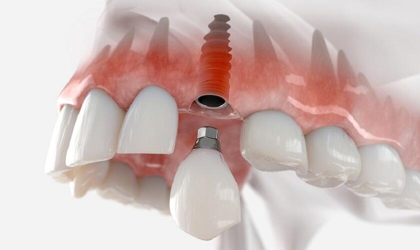 Đối tượng phù hợp để thực hiện quá trình làm răng Implant