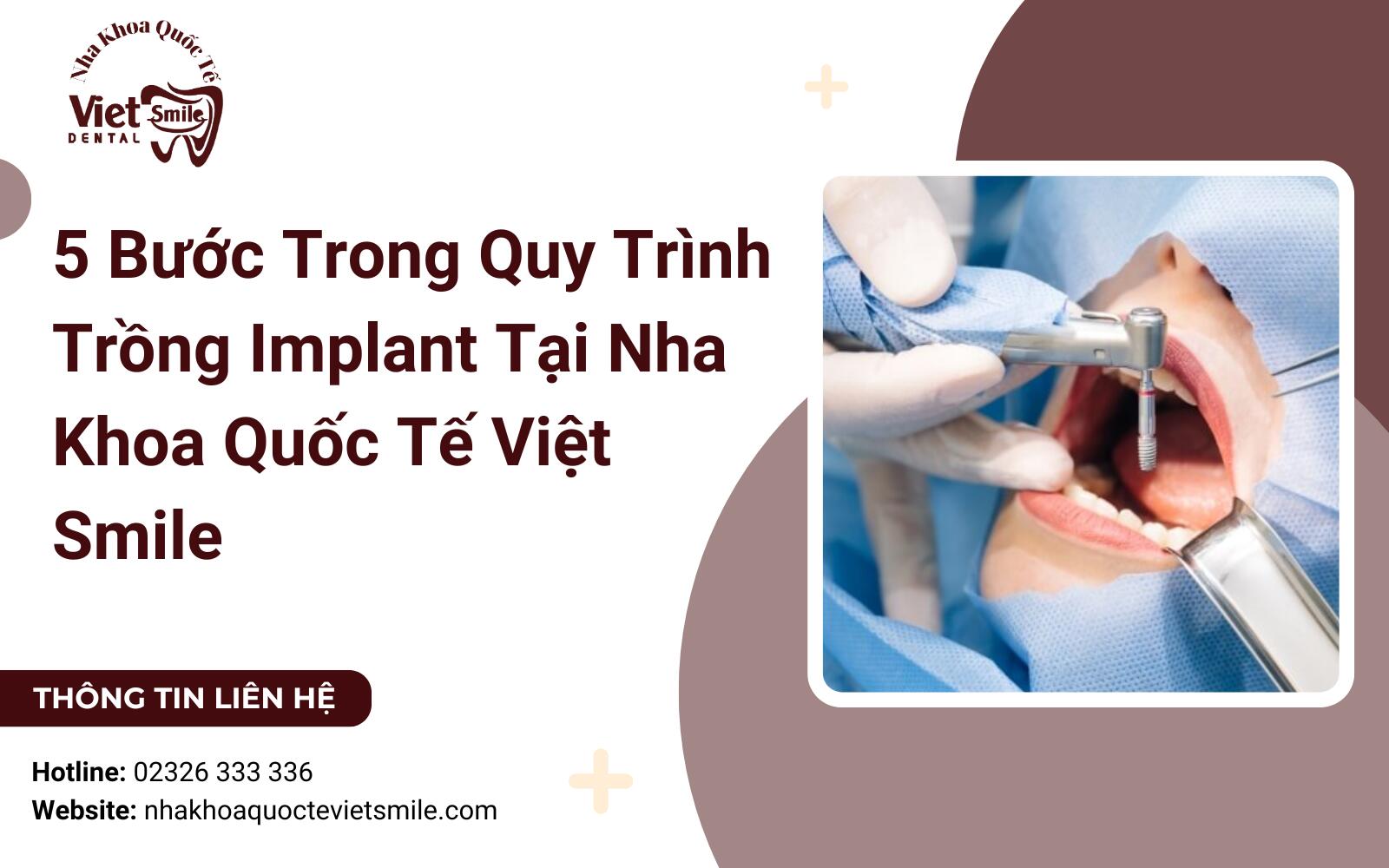 5 Bước Trong Quy Trình Trồng Implant Tại Nha Khoa Quốc Tế Việt Smile