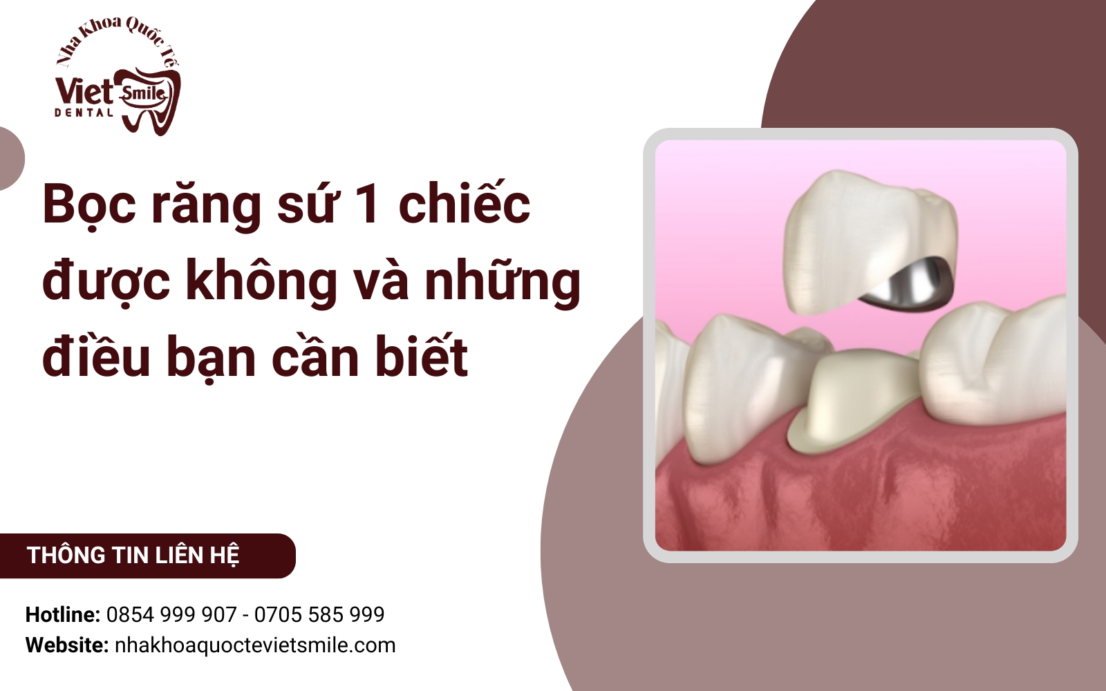 Bọc răng sứ 1 chiếc được không và những điều bạn cần biết
