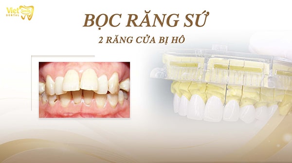 Bọc răng sứ 2 răng cửa bị hô được không?