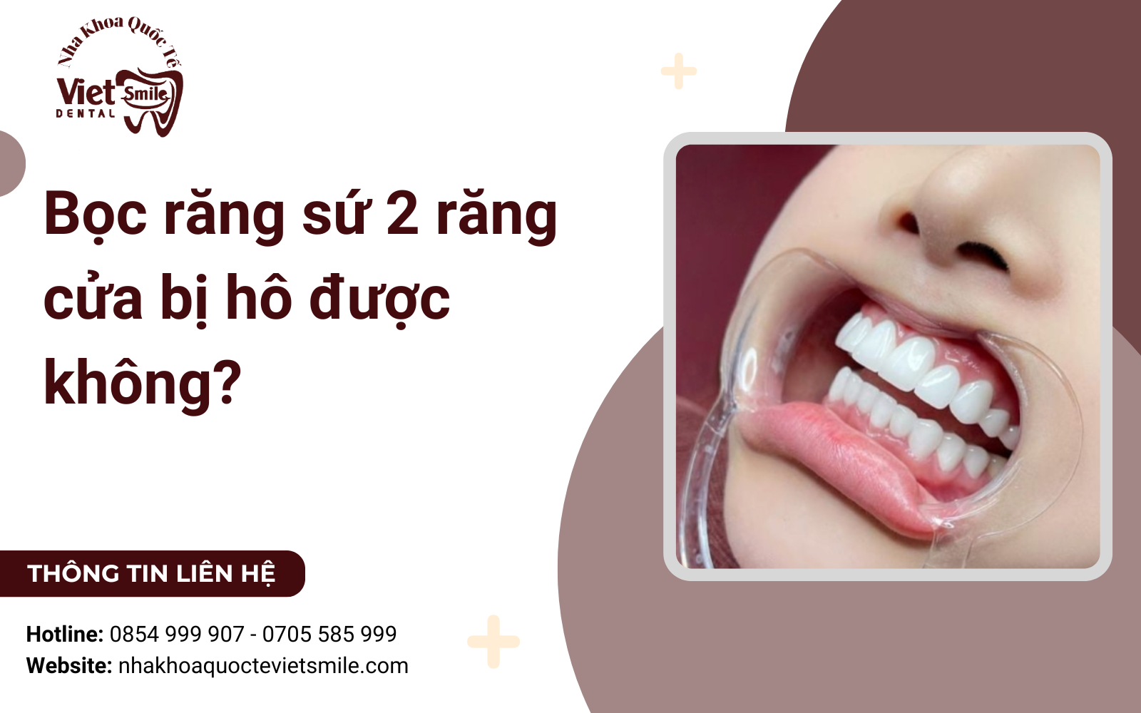 Bọc răng sứ 2 răng cửa bị hô được không?