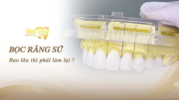 Bọc răng sứ bao lâu thì phải làm lại? Loại răng sứ nào bền nhất