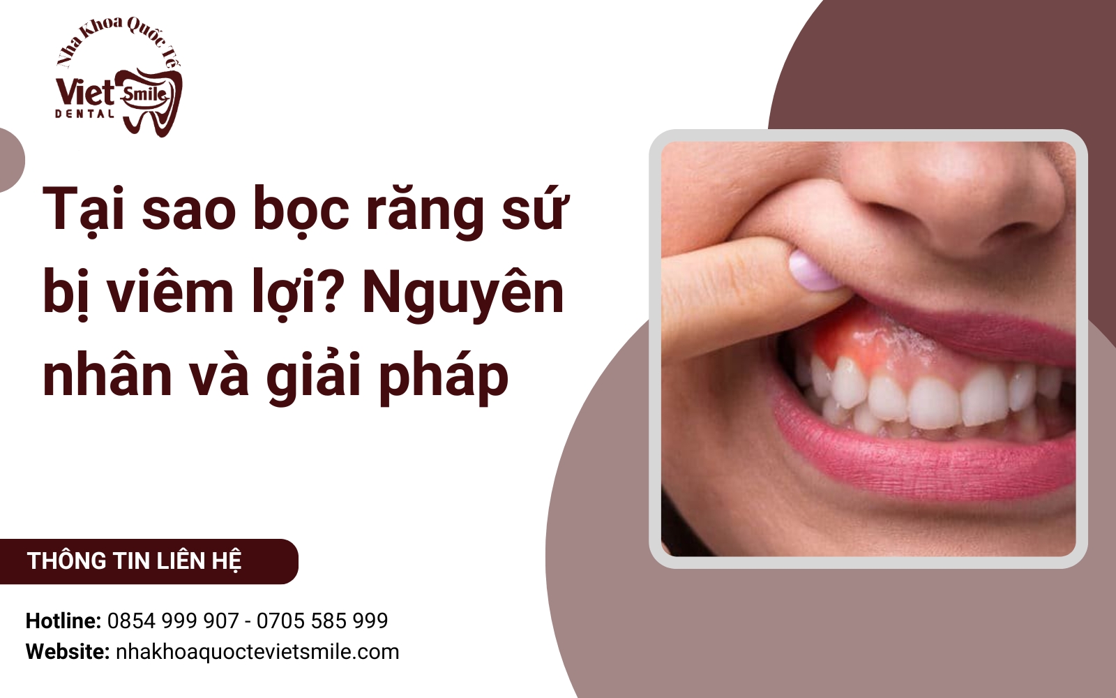 Tại sao bọc răng sứ bị viêm lợi? Nguyên nhân và giải pháp