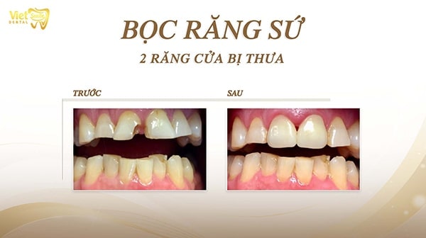 Có nên bọc răng sứ cho răng hô không? 