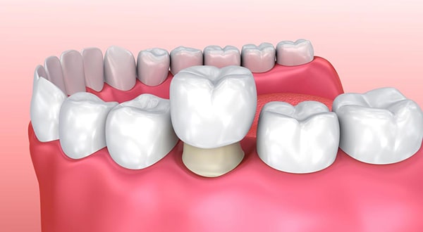 Bọc răng sứ là gì?