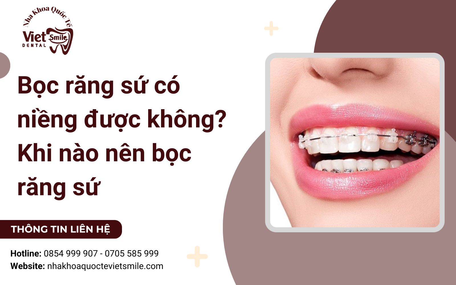 Bọc răng sứ có niềng được không? Khi nào nên bọc răng sứ