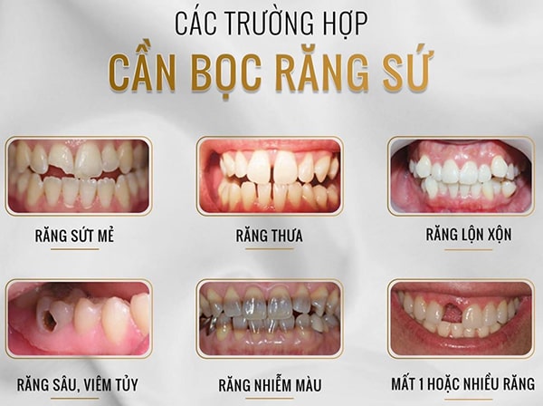 Khi nào nên bọc răng sứ?