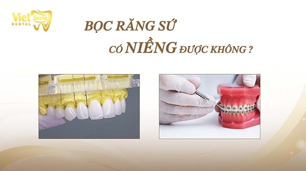 Bọc răng sứ có niềng được không? Khi nào nên bọc răng sứ