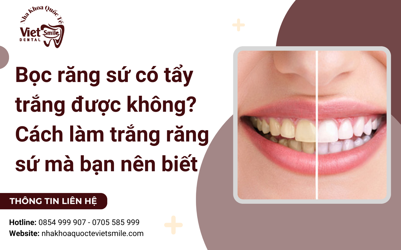 Bọc răng sứ có tẩy trắng được không? Cách làm trắng răng sứ mà bạn nên biết