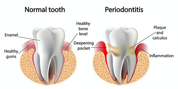 Các bệnh lý về nha chu