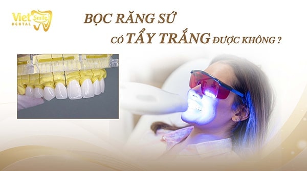 Bọc răng sứ có tẩy trắng được không? Cách làm trắng răng sứ mà bạn nên biết