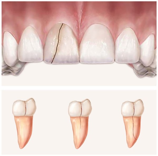 Khi nào cần tháo răng sứ và bọc lại?