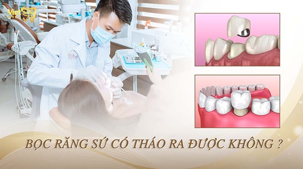 Bọc răng sứ có tháo ra được không? Cần lưu ý gì khi tháo răng sứ?